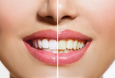 Teeth whitening in Saginaw MI at Passolt Street Family Dental