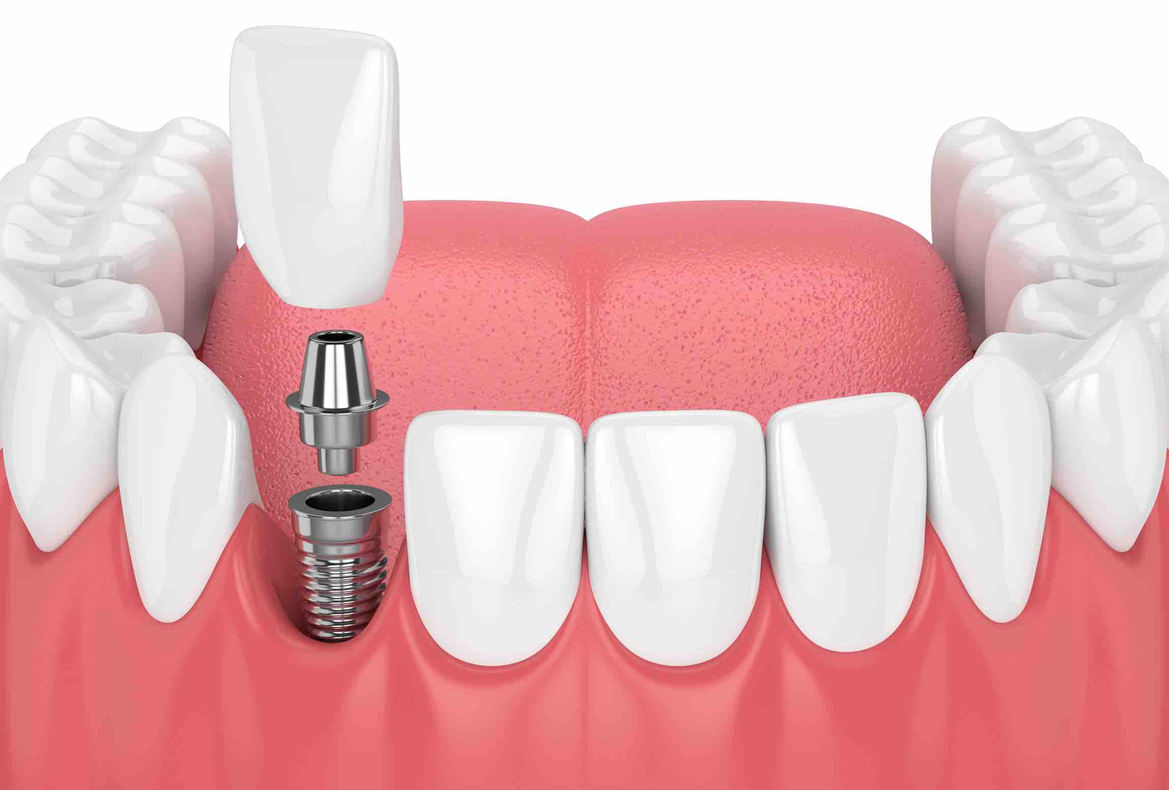 dental implants Saginaw MI at Passolt Street Family Dental