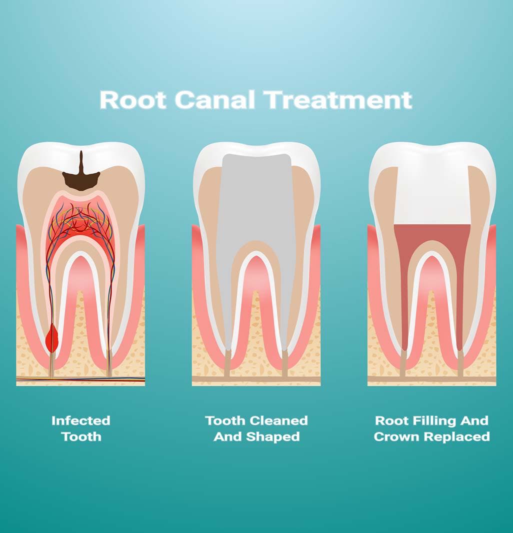 Root Canal Treatment procedure | Passolt Street Family Dental